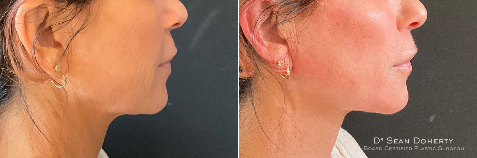NovaThreads Before and After Photos in Boston, MA, Patient 11004