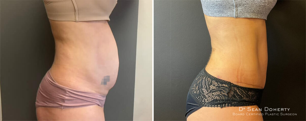 Tummy Tuck Before and After Photos in Boston, MA, Patient 11937