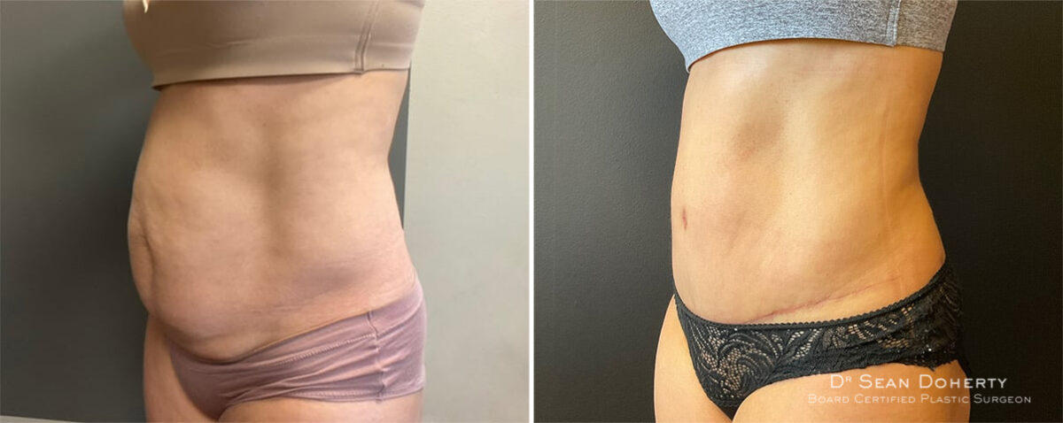 Tummy Tuck Before and After Photos in Boston, MA, Patient 11937
