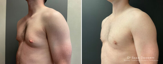 Gynecomastia Before and After Photos in Boston, MA, Patient 11990