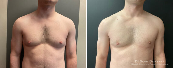 Gynecomastia Before and After Photos in Boston, MA, Patient 11990