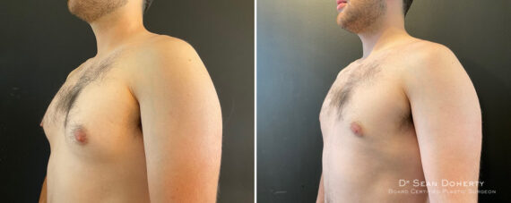 Gynecomastia Before and After Photos in Boston, MA, Patient 11995