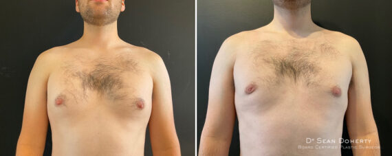 Gynecomastia Before and After Photos in Boston, MA, Patient 11995