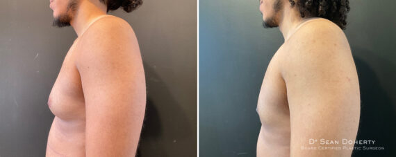 Gynecomastia Before and After Photos in Boston, MA, Patient 12000