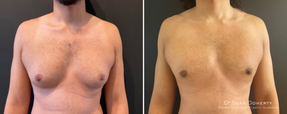 Gynecomastia Before and After Photos in Boston, MA, Patient 12000