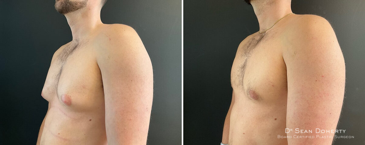 Gynecomastia Before and After Photos in Boston, MA, Patient 12005