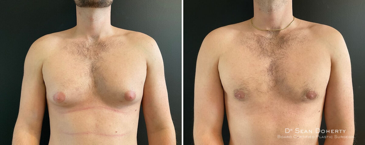 Gynecomastia Before and After Photos in Boston, MA, Patient 12005