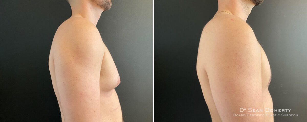 Gynecomastia Before and After Photos in Boston, MA, Patient 12005