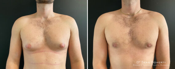 Gynecomastia Before and After Photos in Boston, MA, Patient 12005