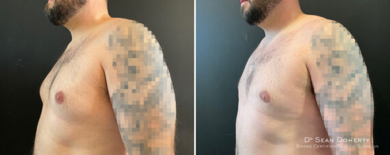 Gynecomastia Before and After Photos in Boston, MA, Patient 12010