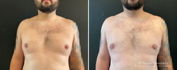 Gynecomastia Before and After Photos in Boston, MA, Patient 12010