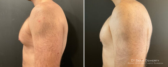 Gynecomastia Before and After Photos in Boston, MA, Patient 12015