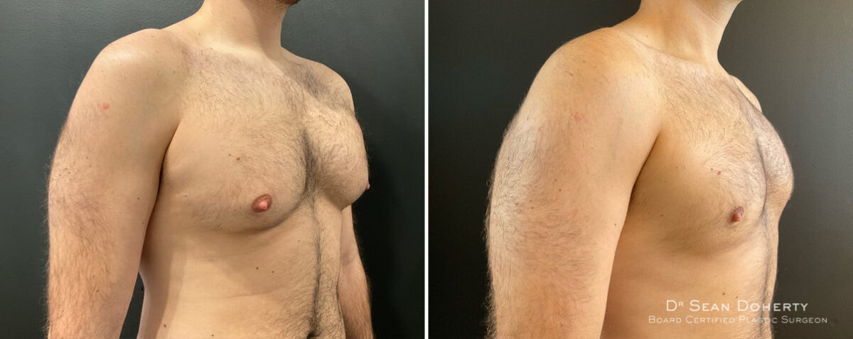 Gynecomastia Before and After Photos in Boston, MA, Patient 12015