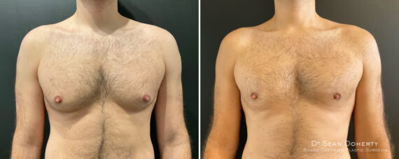 Gynecomastia Before and After Photos in Boston, MA, Patient 12015