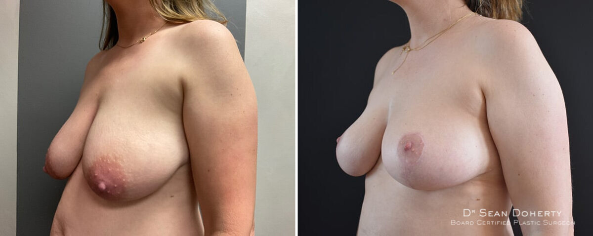 Breast Lift Before and After Photos in Boston, MA, Patient 12042