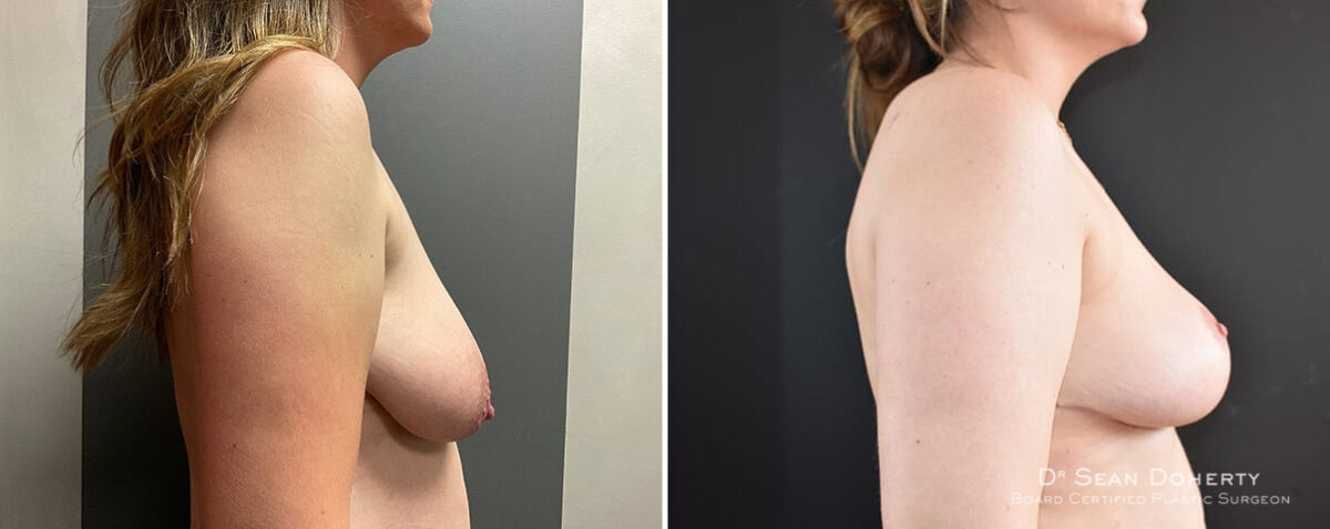 Breast Lift Before and After Photos in Boston, MA, Patient 12042