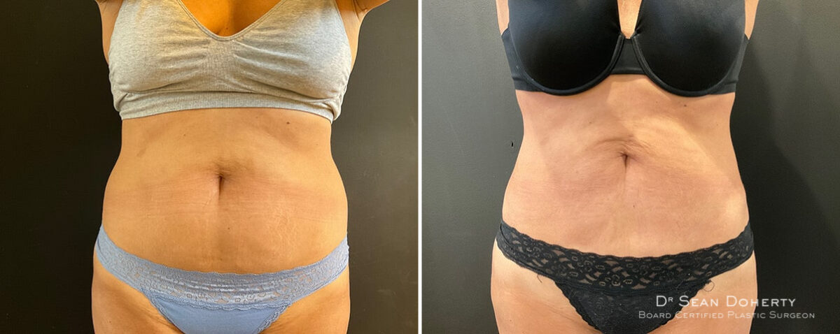 Liposuction Before and After Photos in Boston, MA, Patient 12107
