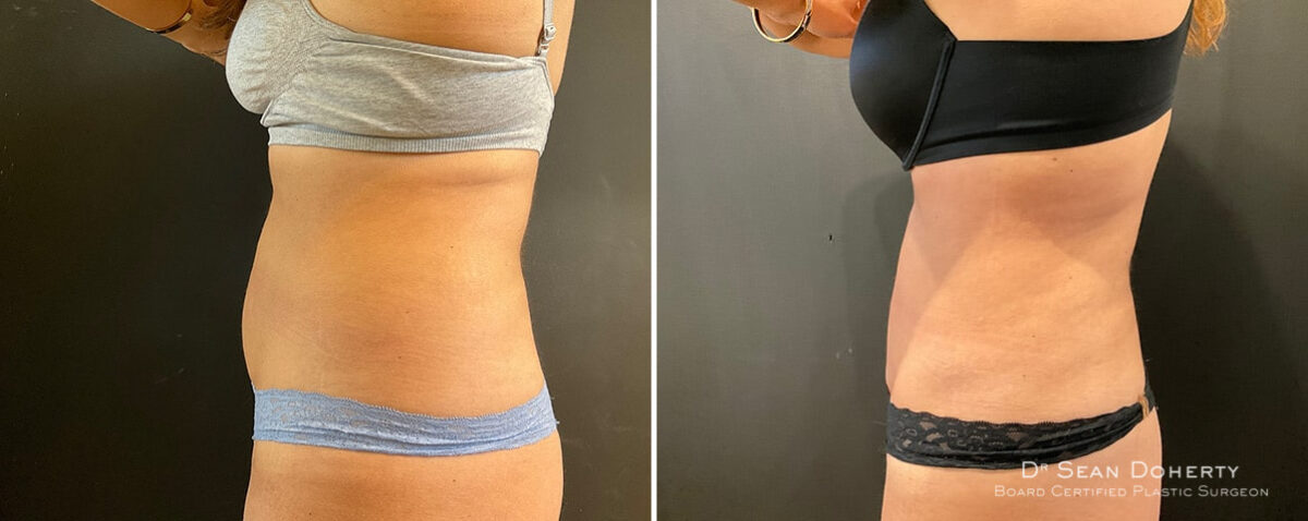 Liposuction Before and After Photos in Boston, MA, Patient 12107