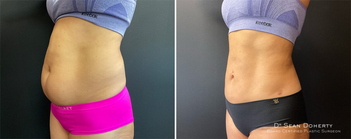 Liposuction Before and After Photos in Boston, MA, Patient 12112