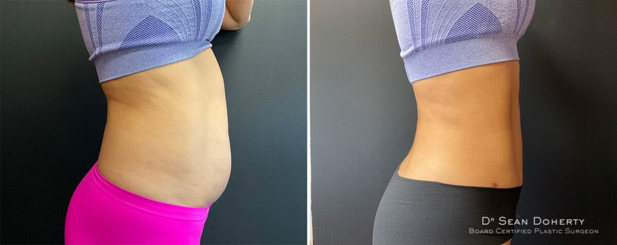 Liposuction Before and After Photos in Boston, MA, Patient 12112