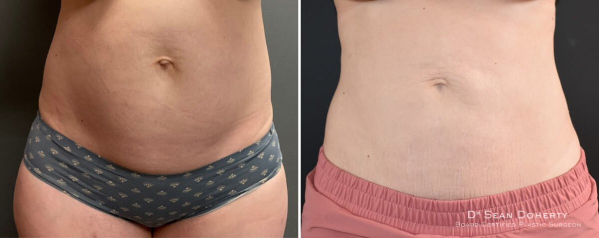 Liposuction Before and After Photos in Boston, MA, Patient 12117
