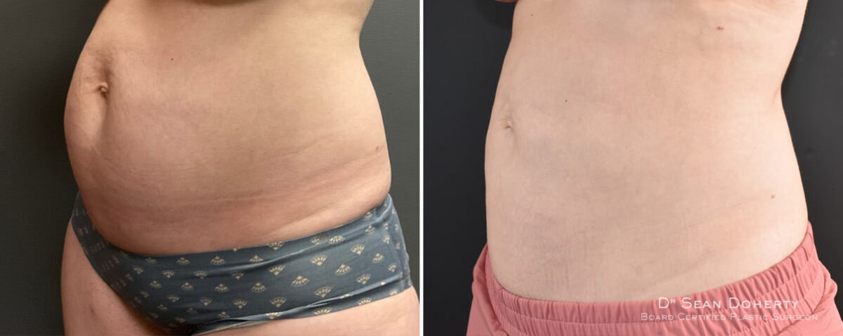 Liposuction Before and After Photos in Boston, MA, Patient 12117