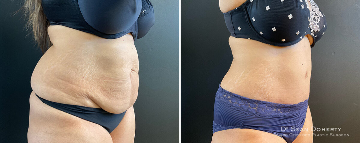 Tummy Tuck Before and After Photos in Boston, MA, Patient 13821
