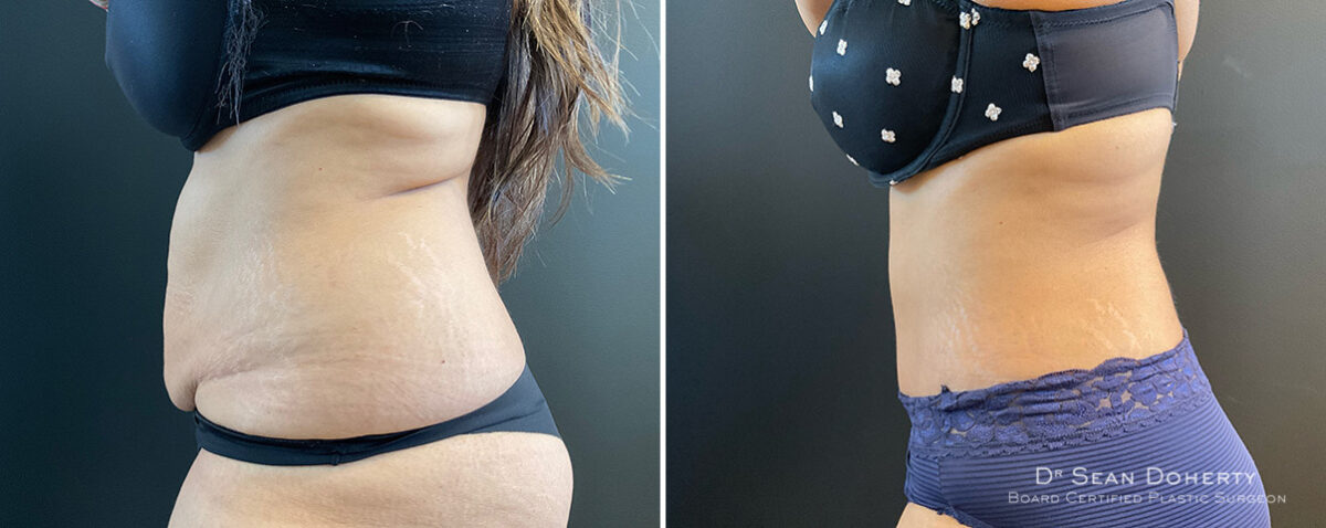 Tummy Tuck Before and After Photos in Boston, MA, Patient 13821