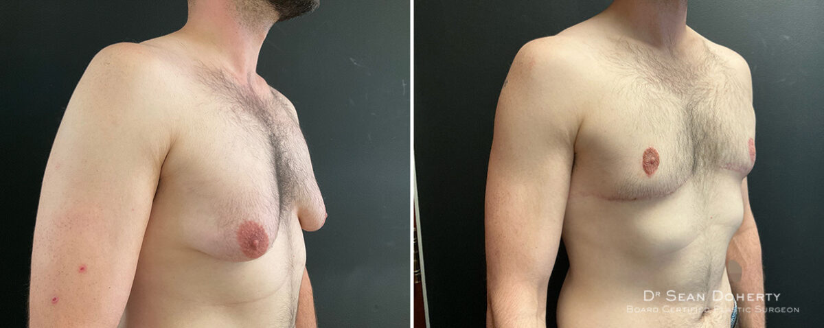 Gynecomastia Before and After Photos in Boston, MA, Patient 13908