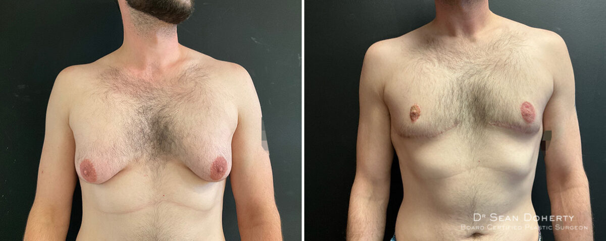 Gynecomastia Before and After Photos in Boston, MA, Patient 13908