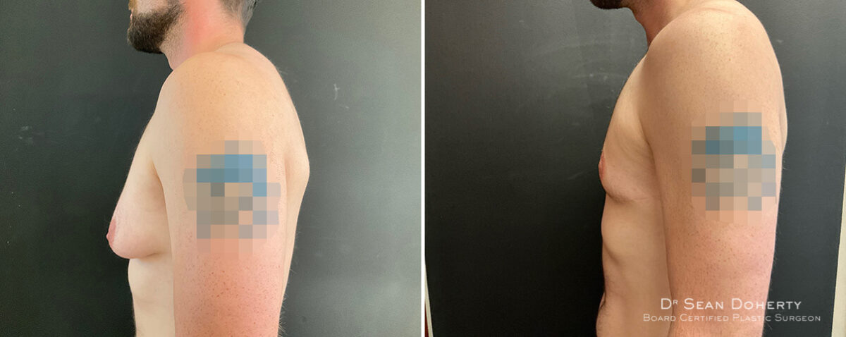 Gynecomastia Before and After Photos in Boston, MA, Patient 13908