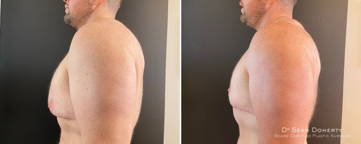 Gynecomastia Before and After Photos in Boston, MA, Patient 13918