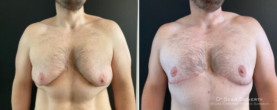 Gynecomastia Before and After Photos in Boston, MA, Patient 13918