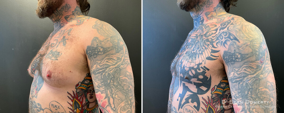 Gynecomastia Before and After Photos in Boston, MA, Patient 13928