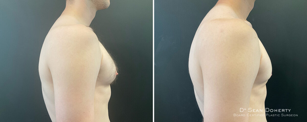 Gynecomastia Before and After Photos in Boston, MA, Patient 13938