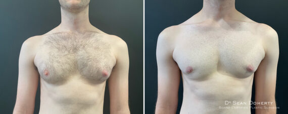 Gynecomastia Before and After Photos in Boston, MA, Patient 13938