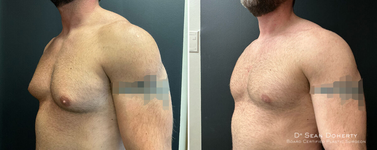 Gynecomastia Before and After Photos in Boston, MA, Patient 13948