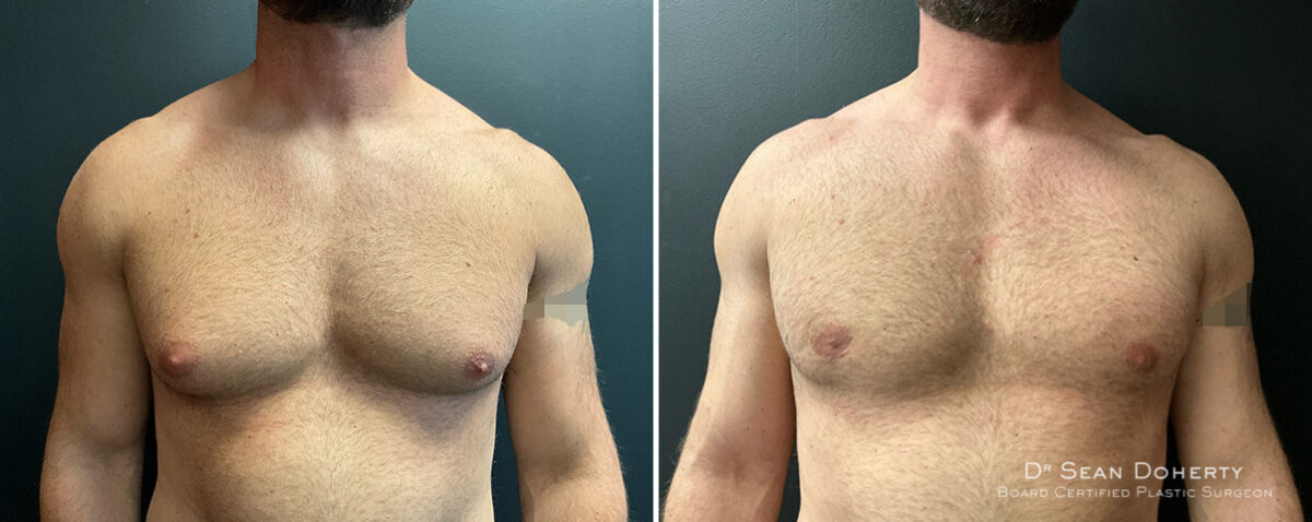 Gynecomastia Before and After Photos in Boston, MA, Patient 13948