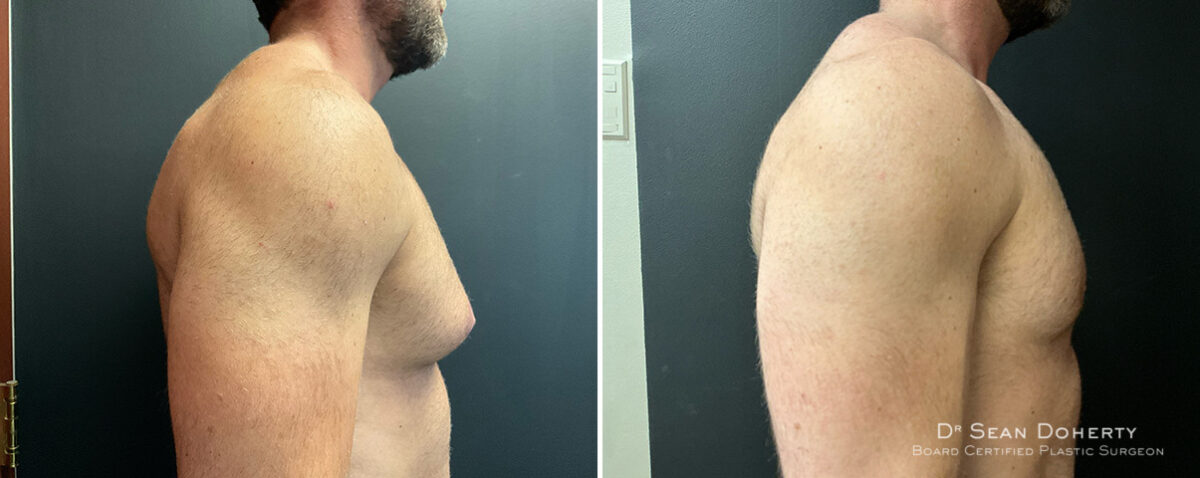 Gynecomastia Before and After Photos in Boston, MA, Patient 13948