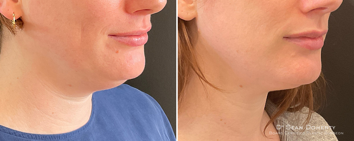 Neck Liposuction Before and After Photos in Boston, MA, Patient 13968