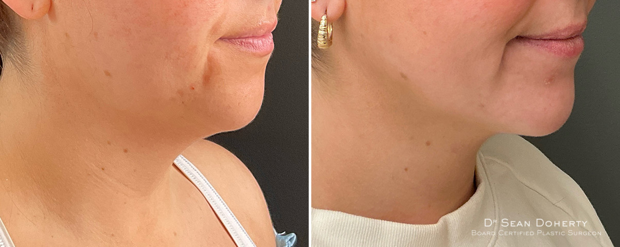 Neck Liposuction Before and After Photos in Boston, MA, Patient 13978