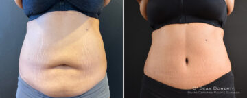 Tummy Tuck Before and After Photos in Boston, MA, Patient 14411