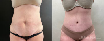 Tummy Tuck Before and After Photos in Boston, MA, Patient 14422