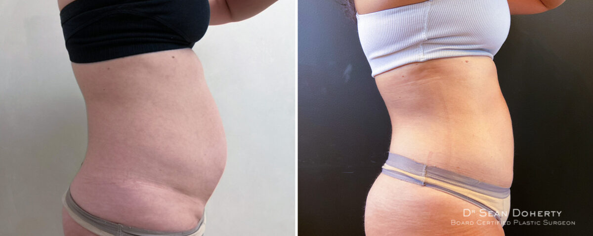 Liposuction Before and After Photos in Boston, MA, Patient 14497