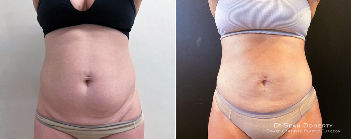Liposuction Before and After Photos in Boston, MA, Patient 14497