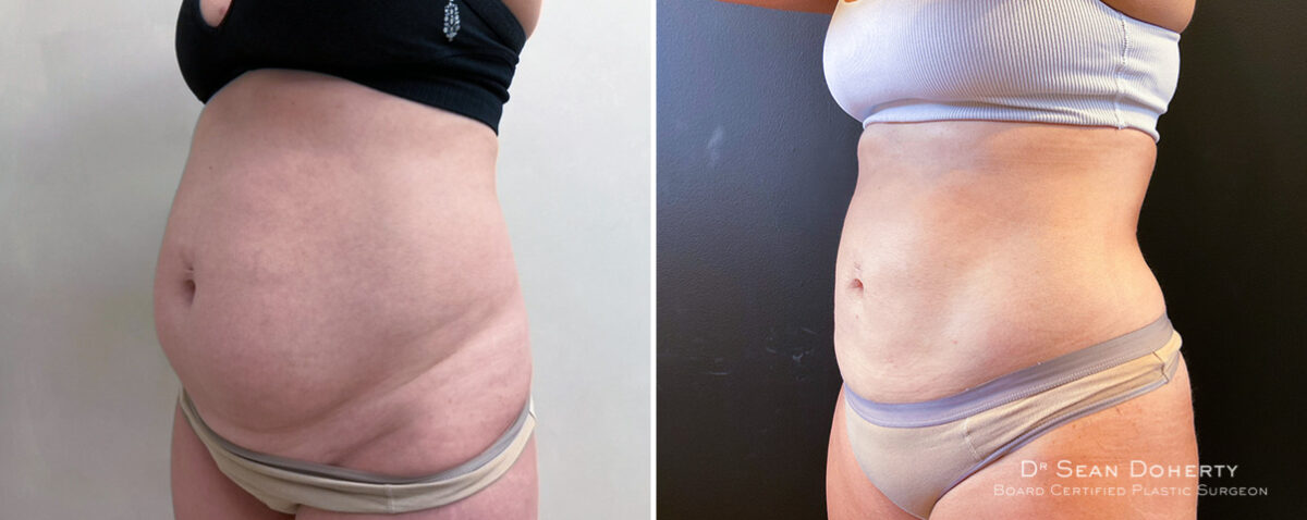 Liposuction Before and After Photos in Boston, MA, Patient 14497
