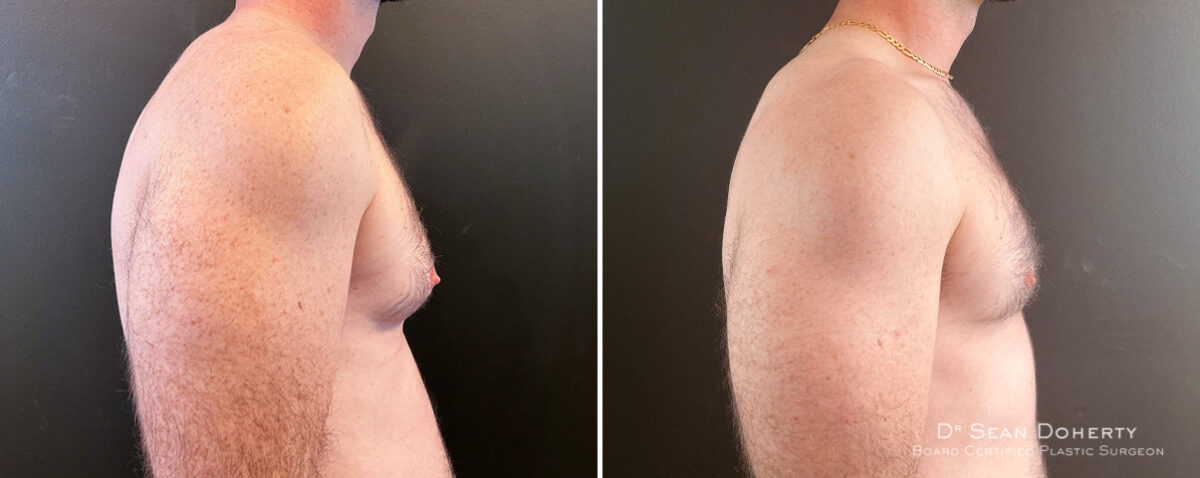 Gynecomastia Before and After Photos in Boston, MA, Patient 14507