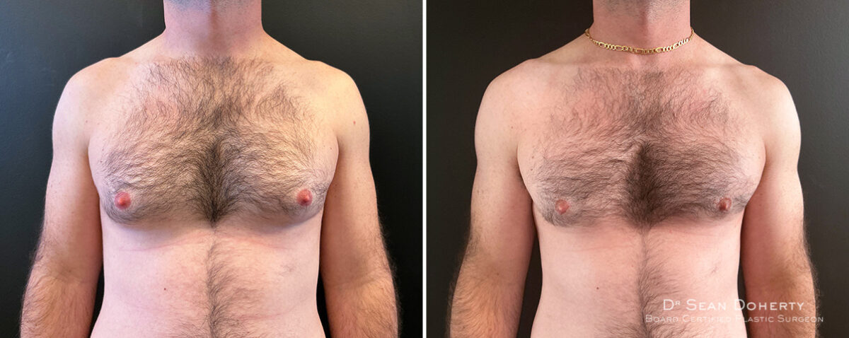 Gynecomastia Before and After Photos in Boston, MA, Patient 14507