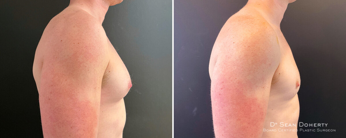 Gynecomastia Before and After Photos in Boston, MA, Patient 14517
