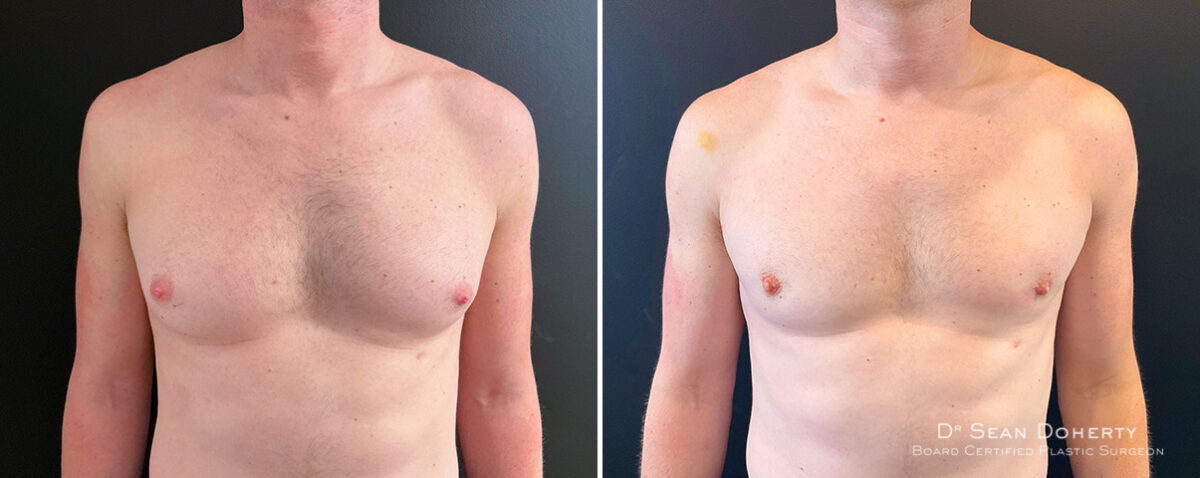 Gynecomastia Before and After Photos in Boston, MA, Patient 14517